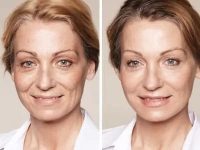 DermalFillers02