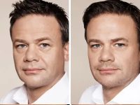 DermalFillers03