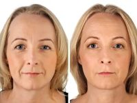 DermalFillers04