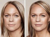 DermalFillers05
