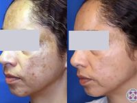 Laser-melasma-tretment-before-and-after