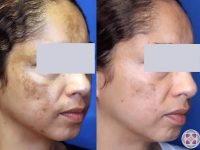 Laser-melasma-tretment-before-and-after2