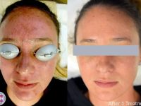 MelasmaBeforeandAfter01