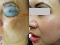 MelasmaBeforeandAfter02