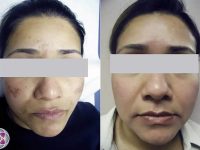 MelasmaBeforeandAfter03