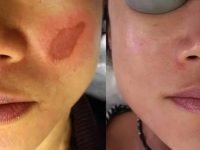MelasmaBeforeandAfter04