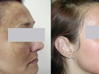 MelasmaBeforeandAfter05