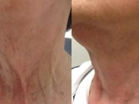NeckTighteningBeforeAndAfter01