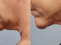 NeckTighteningBeforeAndAfter04