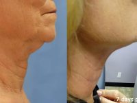 NeckTiteTurkeyNeckLiftBeforeandAfter