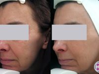 SpectraLift-laser-Facelift-before-and-after-treatment-2
