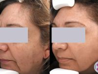 SpectraLift-laser-Facelift-before-and-after-treatment