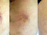 SpiderVeinBeforeandAfter