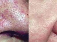 SpiderVeinBeforeandAfter2