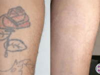TattooRemovalBeforeandAfter01