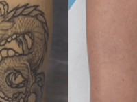 TattooRemovalBeforeandAfter02
