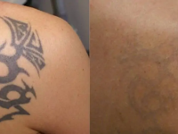 TattooRemovalBeforeandAfter03