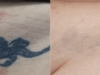 TattooRemovalBeforeandAfter04