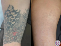 TattooRemovalBeforeandAfter05