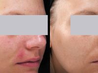 acne-rosacea-before-and-after-treatment
