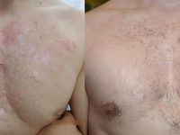 acne-scars-chest-before-and-after-lasers-subcision-stem-cells