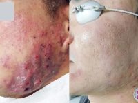 acne-treatment-before-and-after-4