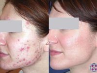 acne-treatment-results-before-and-after-1