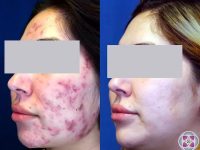 acne-treatment-results-from-lasers