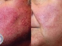 before-and-after-laser-treatment-for-rosacea