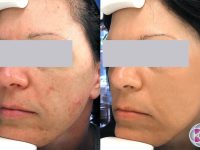 best-acne-treatment-orange-county