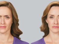 botox-cosmetic-for-forehead-wrinkles