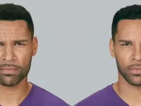 botox-cosmetic-for-male-forehead-wrinkles