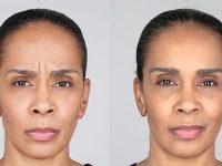 botox-cosmetic-injections-female