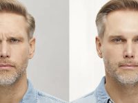 botox-for-wrinkles-in-men