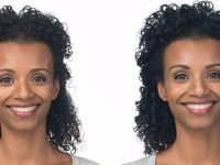 botoxbeforeandafter04