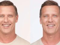 botoxbeforeandafter05
