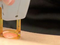 brazilian-laser-hair-removal-copy