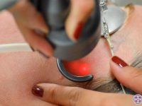 close-up-of-co2-fractional-laser-ama-regenerative-medicine-skincare