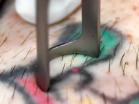 close-up-of-yag-laser-tattoo-removal