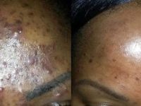 cystic-acne-treatment-with-lasers-before-after-2