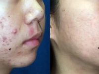 cystic-acne-treatment-with-lasers-before-after