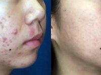 cystic-acne-treatment-with-lasers-before-after