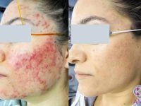 cystic-acne-treatment-with-lasers-before-after4