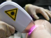 diode-laser-hair-removal-on-legs-ama-skincare