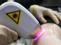 diode-laser-hair-removal-on-legs-ama-skincare