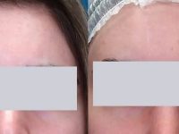 forehead-scar-removal