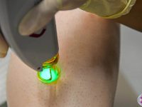 green-laser-hair-removal-on-leg-ama-skincare