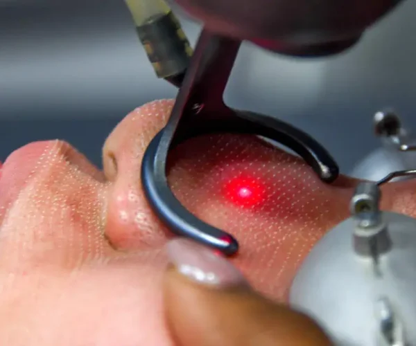 header-co2-fractional-laser-type-3