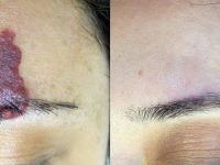 hemangioma laser red birthmark removal