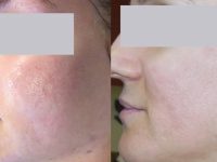 laser-acne-scar-removal